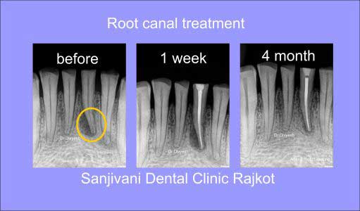 Intra Oral Camera