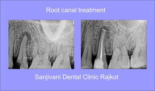 Intra Oral Camera