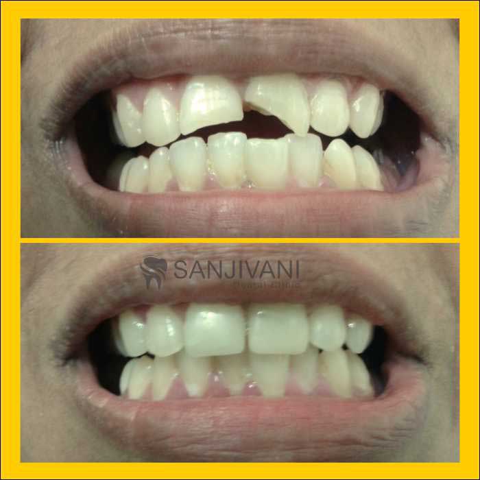 Dental X-Rays