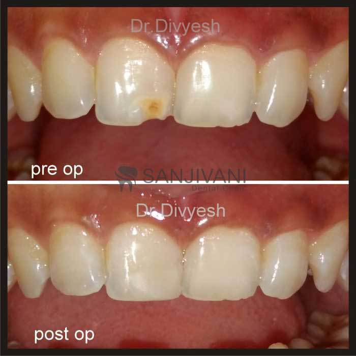 Dental X-Rays