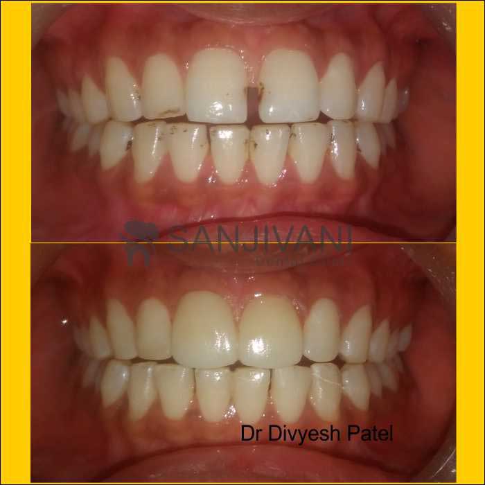 Intra Oral Camera