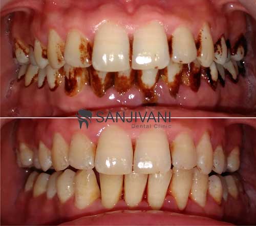 Dental X-Rays
