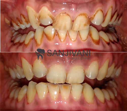 Dental X-Rays