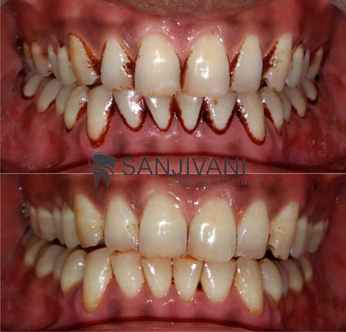 Intra Oral Camera