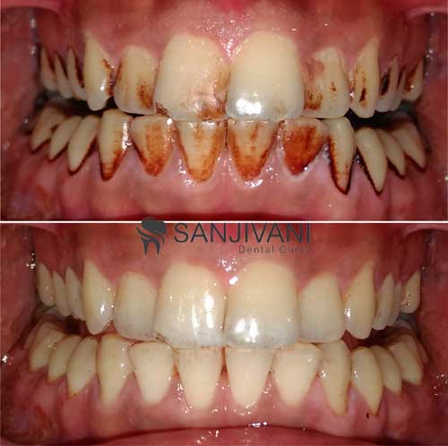 Intra Oral Camera