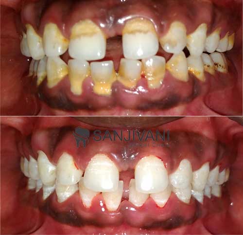 Dental X-Rays