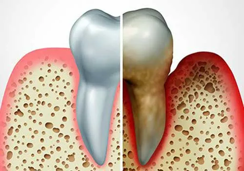 Gum Disease Treatment