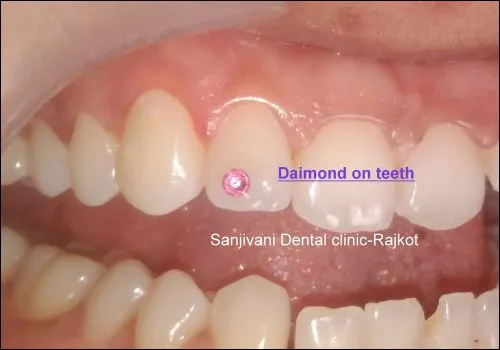 Diamond on Teeth