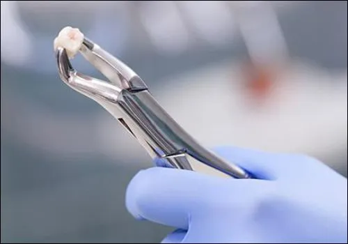 Tooth Removal