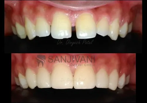 Dental Veneers/Smile Correction