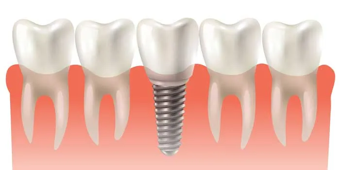 Dental Implant
