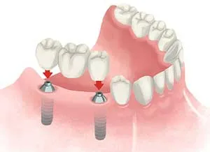 Dental Implant
