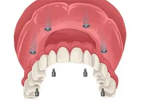 Dental Implant