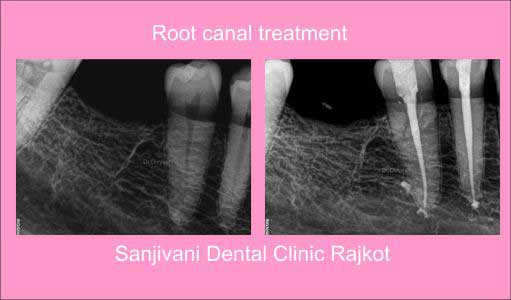 Dental Implant 5