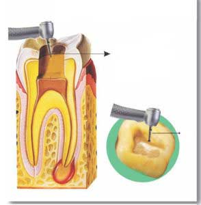 Dental Implant