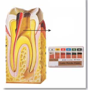 Dental Implant