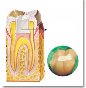 Dental Implant