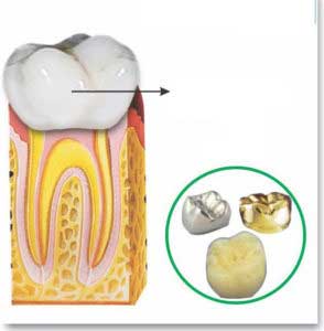 Dental Implant