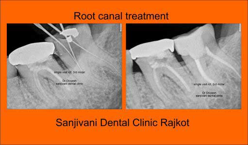 Dental Implant 6