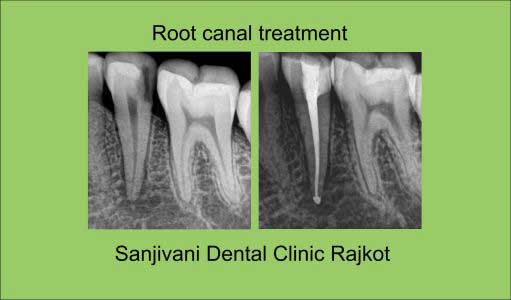 Dental Implant 3
