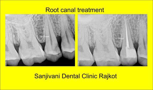 Dental Implant 2