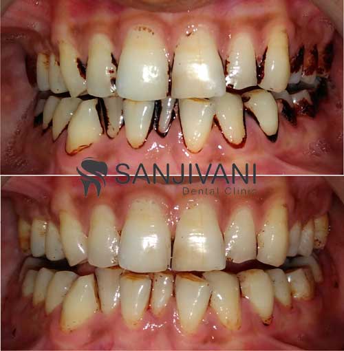 Gutkha Stain Removal
