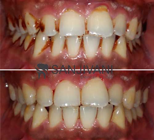 Tartar Removal
