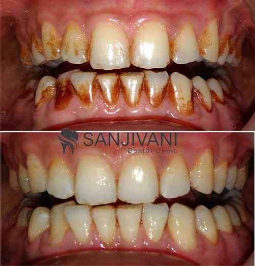 Tobacco Stain Removal