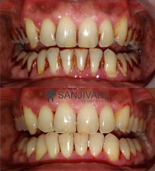 Tobacco Stain Removal 2