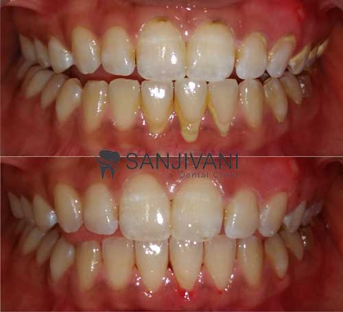 Tooth Cleaning in Gujarat