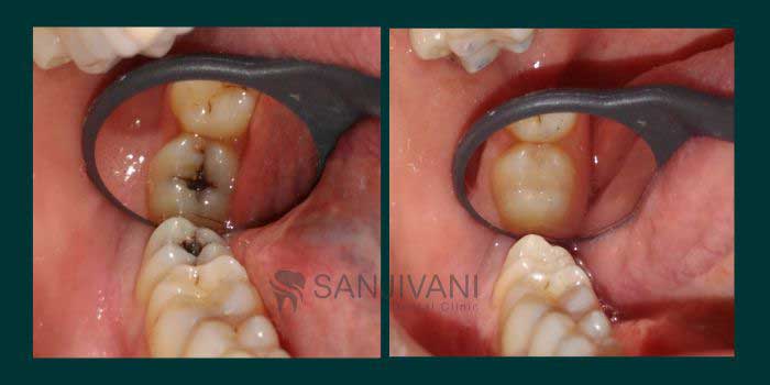 Dental Implant