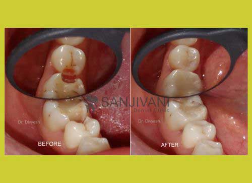 Dental Implant 3