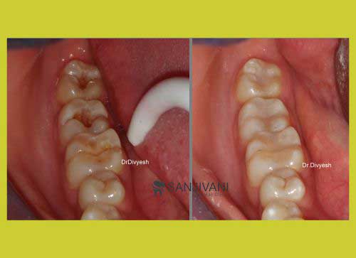 Dental Implant 4