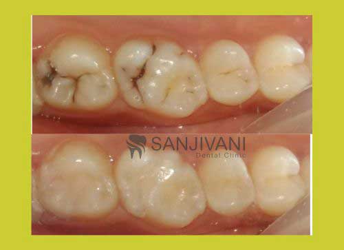 Dental Implant 5
