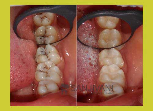 Dental Implant 6