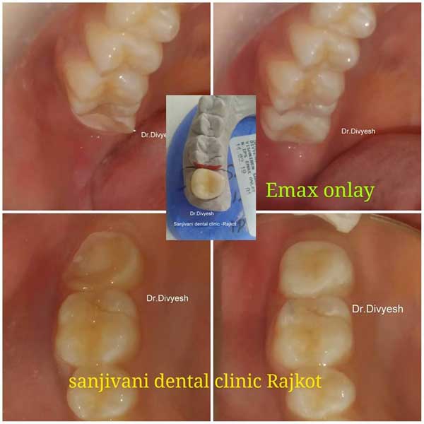 Dental Implant