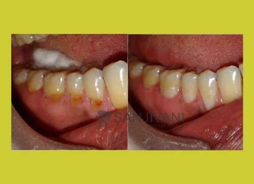 Dental Implant