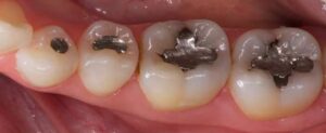 Dental Implant
