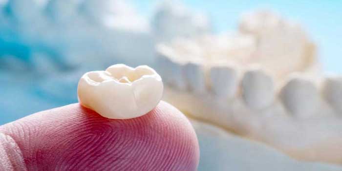 Dental Implant