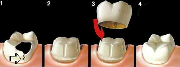 Dental Implant
