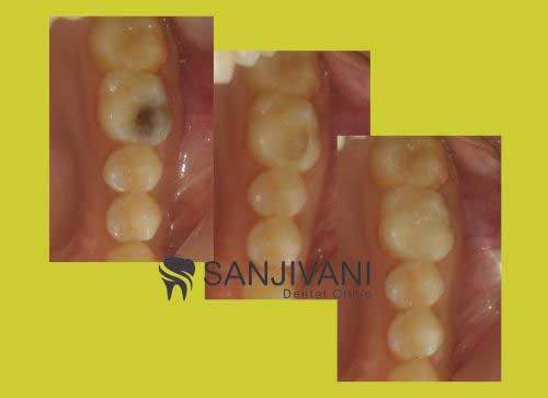 Dental Implant