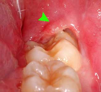 Infection in Wisdom Tooth