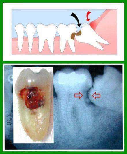 Wisdom Tooth Decay