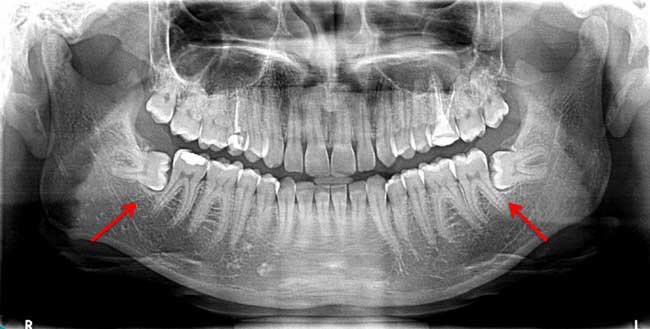 Dental Implant