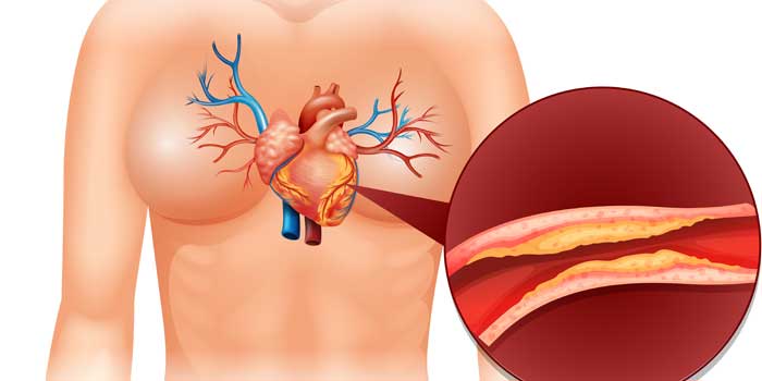 Can gum disease cause heart attack