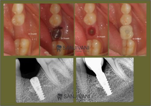 Dental Treatment 1 Dental implant in rajkot