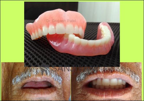 Dental Treatment 15 denture in rajkot