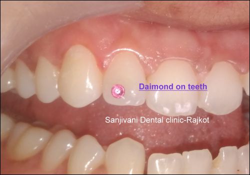 Dental Treatment 13 diamond on teeth