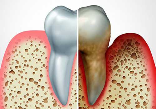 Dental Treatment 12 gum-disease-treatment