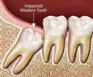 impacted wisdom tooth